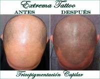 /album/micropigmentacion/extrema-tattoo-tricopigmentacion-b-jpg/